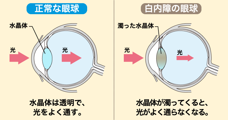 m正常な眼球と白内障の眼球